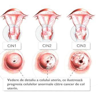 Cancer col uterin: progresia catre cancer, Foto: www.cancercoluterin.ro