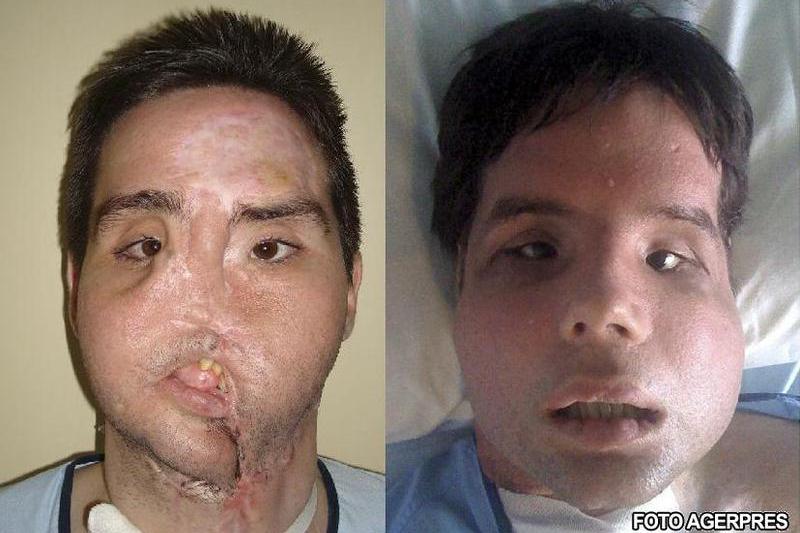 Oscar, inainte si dupa transplant, Foto: Agerpres