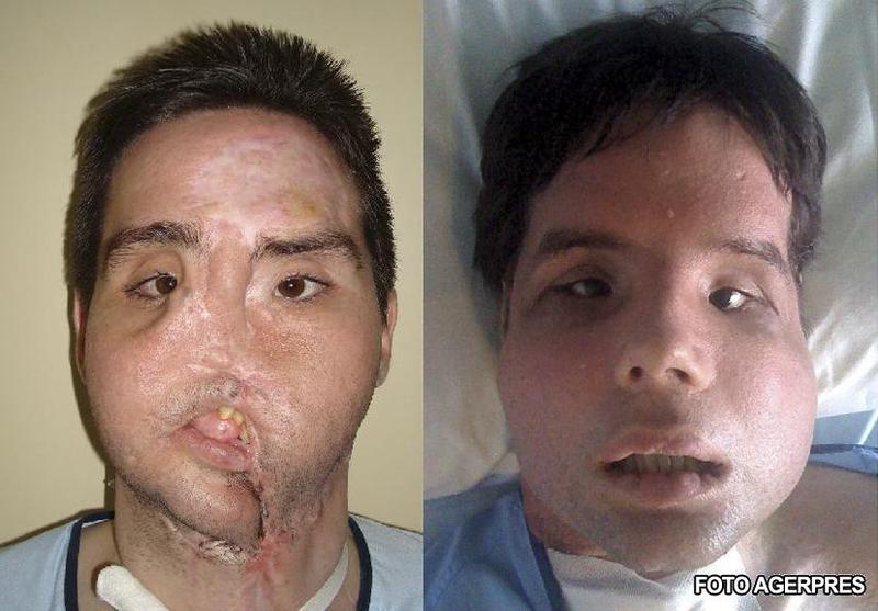 Oscar, inainte si dupa transplant, Foto: Agerpres