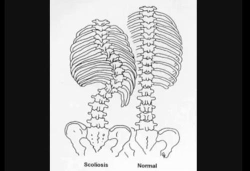 Scolioza deformeaza coloana vertebrala, Foto: Captura Youtube.com
