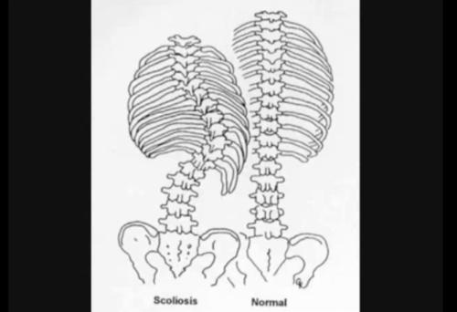 Scolioza deformeaza coloana vertebrala , Foto: Captura Youtube.com