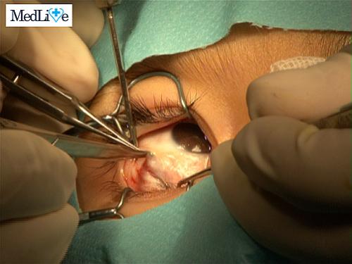 Operatie nistagmus, Foto: MedLive.ro