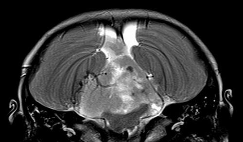 Tumora era dezvoltata in trunchiul cerebral si extinsa in canalul medular, Foto: MedLife