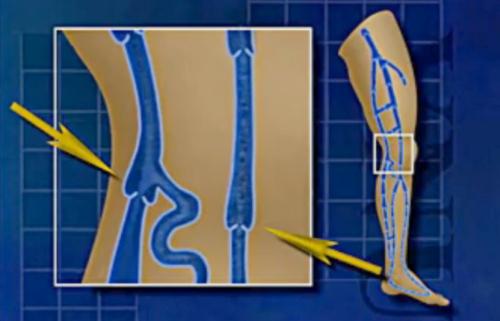 Insuficienta venoasa , Foto: Captura Youtube.com