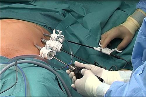 Introducerea trocarelor in tratamentul herniei ombilicale, Foto: Hotnews