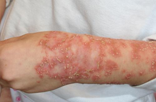 Psoriazis pustular, Foto: Captura YouTube