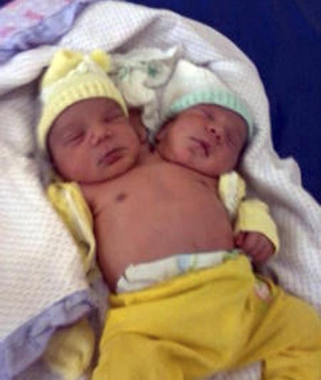 Siamezi cu doua capete si o singura inima, nascuti in Brazilia, Foto: Reuters