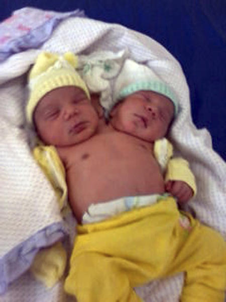 Siamezi cu doua capete si o singura inima, nascuti in Brazilia, Foto: Reuters