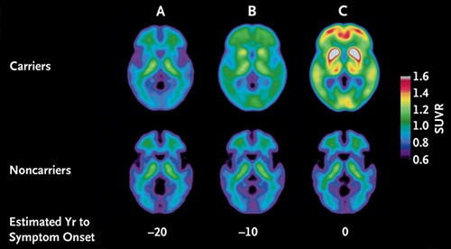 Detectare precoce a bolii Alzheimer, Foto: technologyreview.com