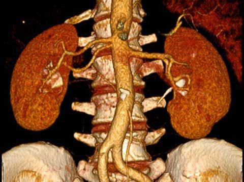 Angiografie CT - artere renale, Foto: MedLife