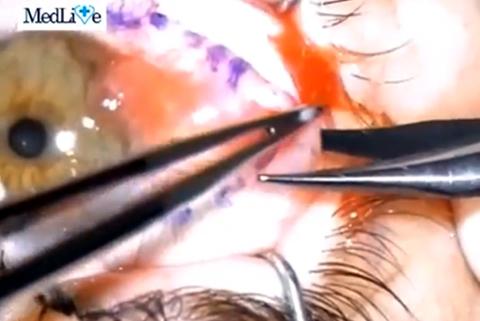 Operatie - tumora corneo-conjunctivala, Foto: Hotnews