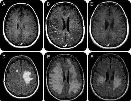 Leziuni ale creierului, Foto: Neurology.org