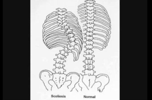 Scolioza deformeaza coloana vertebrala, Foto: Captura YouTube