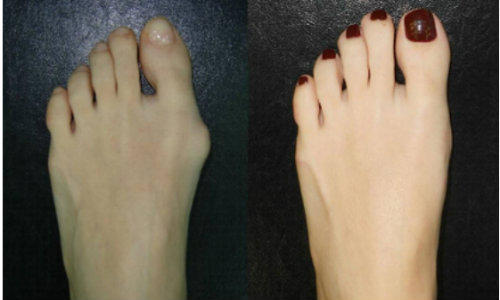 Hallux valgus pre si post-operator, Foto: MedLive.ro