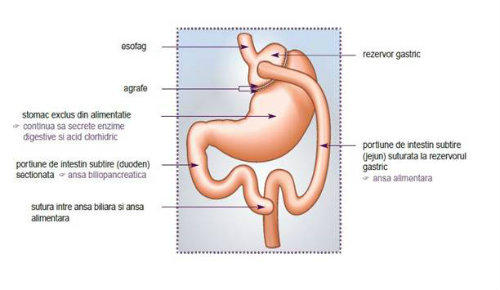 Bypass gastric, Foto: MedLive.ro