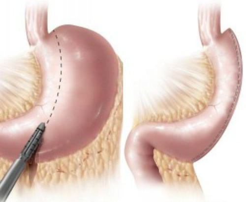 Gastric sleeve- operatia de micsorare a stomacului, Foto: MedLife