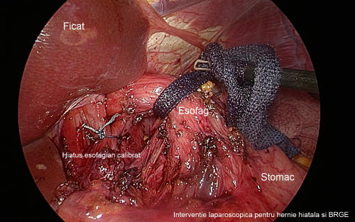 Boala de reflux gastro-esofagian, Foto: MedLive.ro