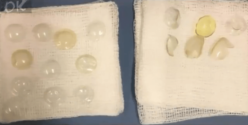 27 de lentile au fost indepartate din ochiul unei femei, Foto: Captura YouTube