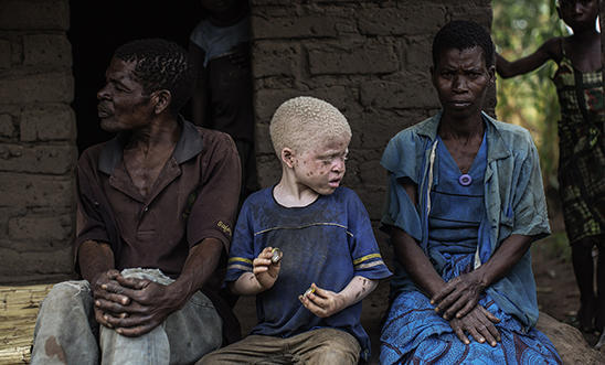 Albinos in Africa, Foto: Amnesty International