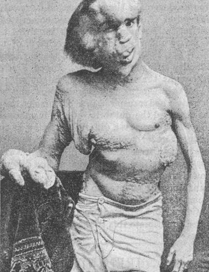 Joseph Merrick 1889, Foto: Wikipedia