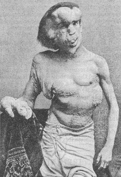 Joseph Merrick 1889, Foto: Wikipedia