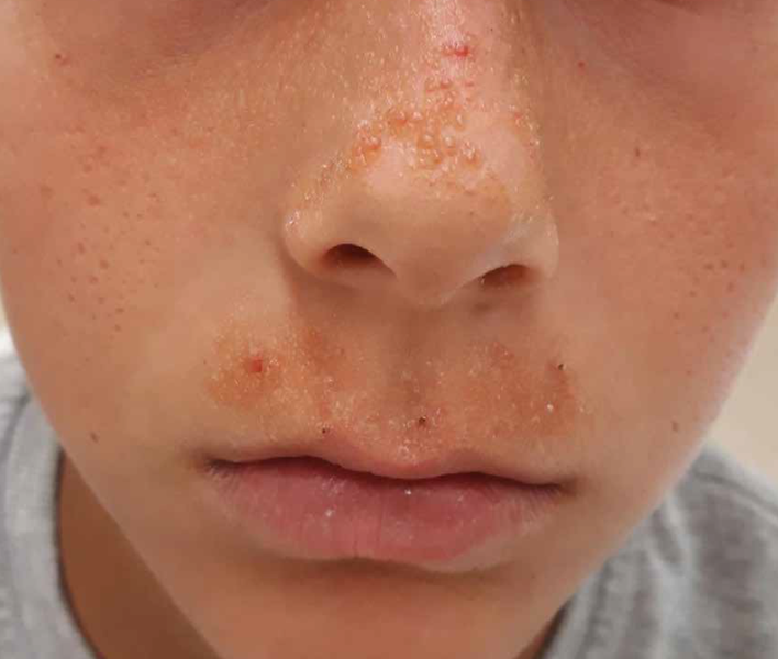 Pacient diagnosticat cu Milium Coloid Juvenil , Foto: MedLife