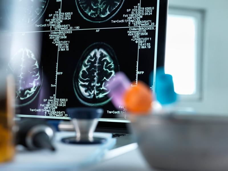 Scanare creier, Foto: TEK IMAGE / Sciencephoto / Profimedia