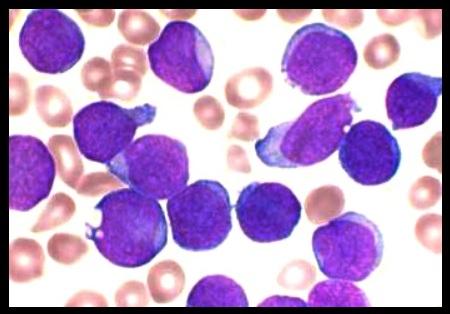 Leucemie, Foto: Wikipedia