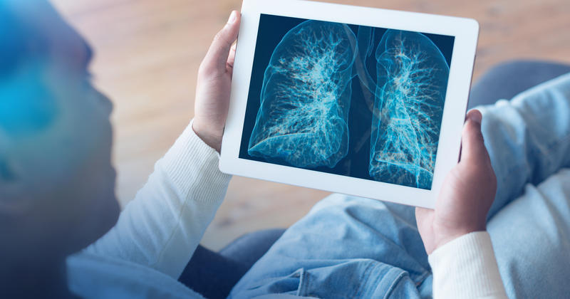 Afectare pulmonara Covid 19, Foto: MedLife