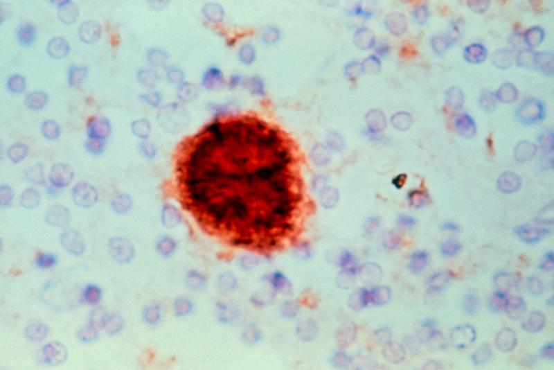 Medicii canadieni afirma ca noua afectiune nu este cauzata de prioni, Foto: Laboratoire Escourolle-Eurelios / Sciencephoto / Profimedia Images
