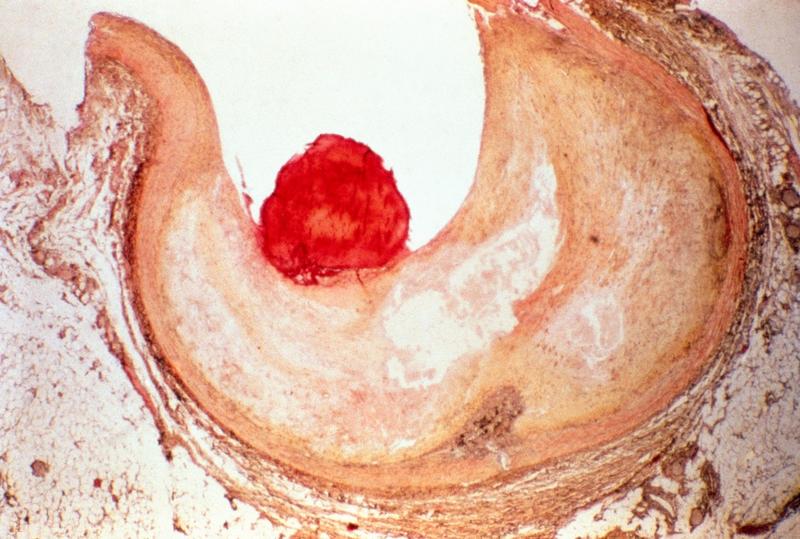 Ateroscleroza, Foto: CNRI / Sciencephoto / Profimedia Images