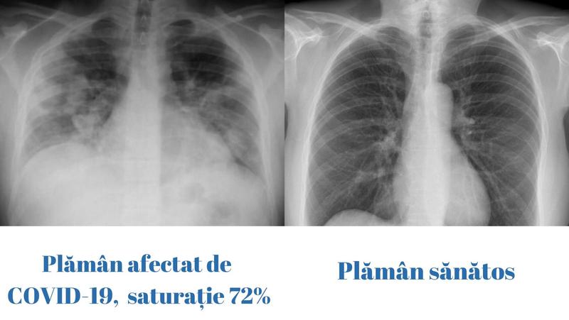 Plaman bolnav de Covid vs plaman sanatos, Foto: CNCAV
