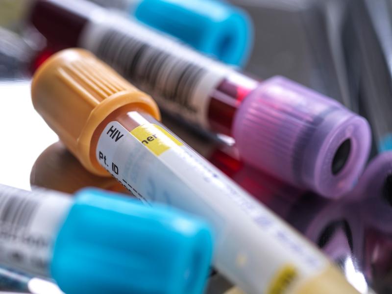 Fiole cu sange infectat cu HIV, Foto: Science Photo Library / Sciencephoto / Profimedia