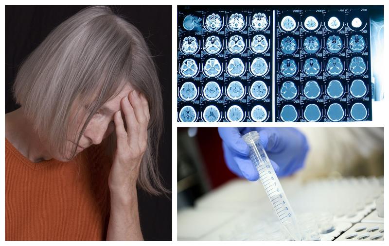 Cercetătorii speră ca vaccinul să ajungă cât mai repede în teste clinice pe oamenifakepathalzheimer-scaled, Foto: fanatik.ro