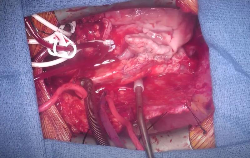 Transplant reusit de inima de porc la om, Foto: YouTube
