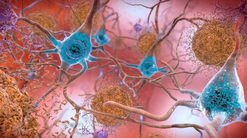 Celule ale creierului afectat de Alzheimer, Foto: National Institute on Aging, NIH / AP / Profimedia