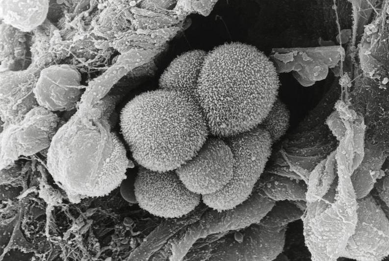 Tumoare canceroasă la plămâni, Foto: MOREDUN ANIMAL HEALTH / Sciencephoto / Profimedia