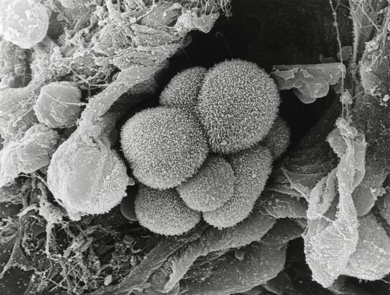 Tumoare canceroasă la plămâni, Foto: MOREDUN ANIMAL HEALTH / Sciencephoto / Profimedia