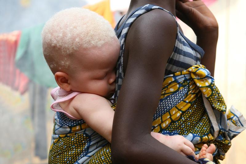 Fetita cu albinism in Africa, Foto: Feije Riemersma / Alamy / Profimedia Images