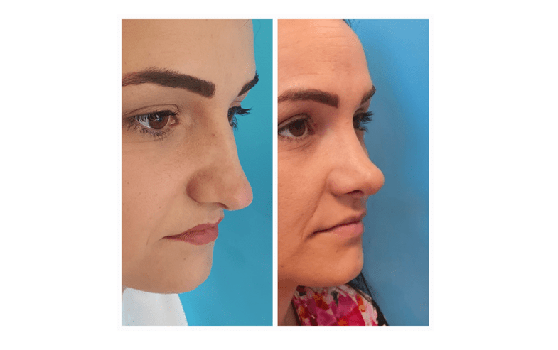 Ana Maria, înainte și după operația de rinoplastie, Foto: Regina Maria