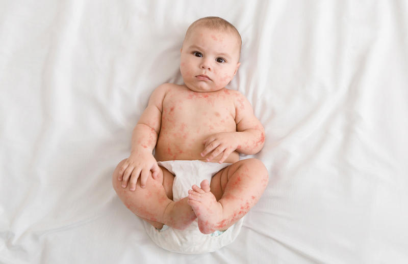 Copil cu rujeolă, Foto: Shutterstock