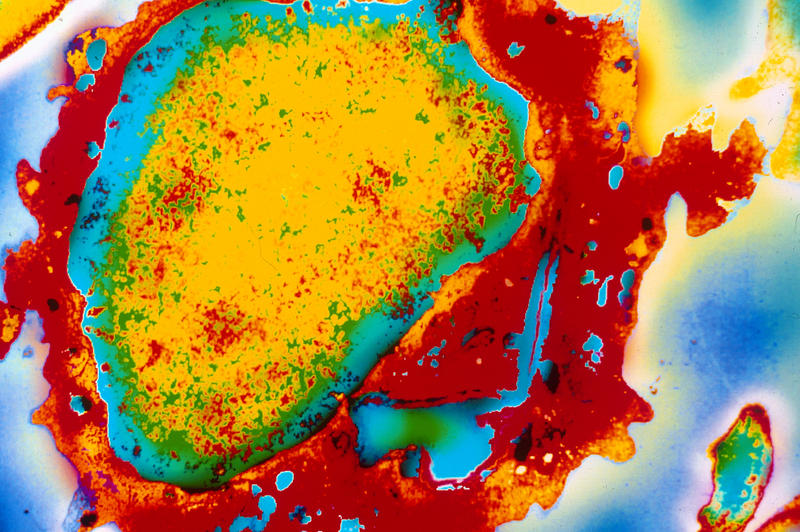Leucemie , Foto: MEULLEMIESTRE / BSIP / Profimedia