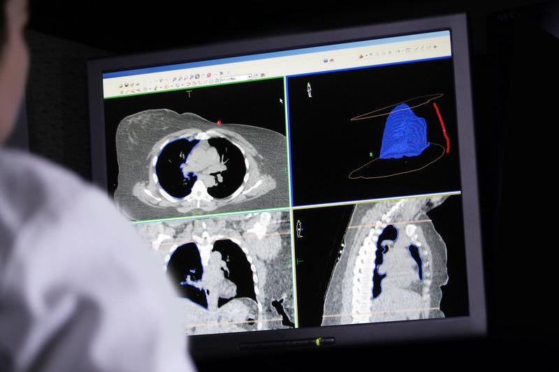 Cancerul pulmonar depistat în stdii incipiente are șanse mult mai mari de vindecare, Foto: © Patricioj | Dreamstime.com