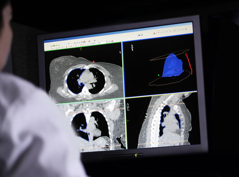 Cancerul pulmonar depistat în stdii incipiente are șanse mult mai mari de vindecare, Foto: © Patricioj | Dreamstime.com