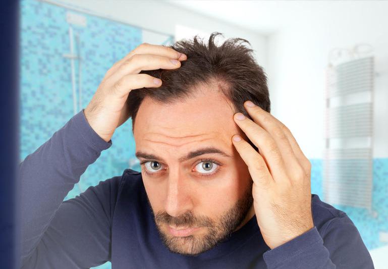 Pierderea părului din cauză ereditară poate afecta atât bărbații, cât și femeile, Foto: © Antonio Gravante | Dreamstime.com