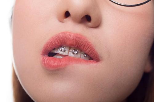 Aparat dentar, Foto: Yaping Ma / Alamy / Alamy / Profimedia