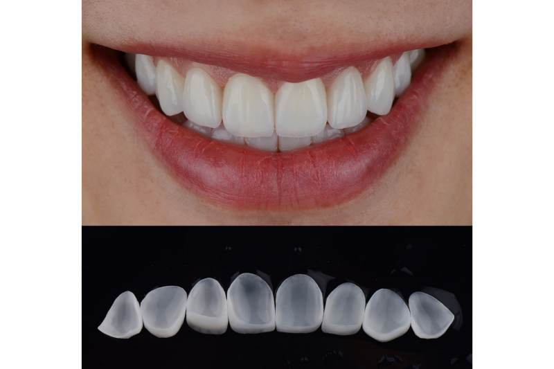 Tipuri de fațete dentare: ceramică, zirconiu și compozit
