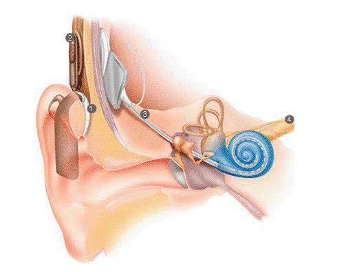 Implant cohlear, Foto: Darul sunetului