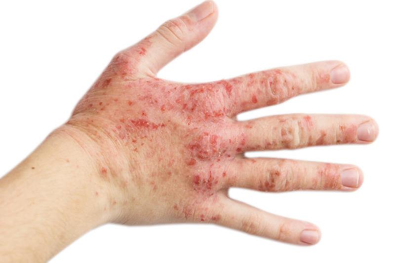 Dermatita atopică, Foto: Injenerker | Dreamstime.com