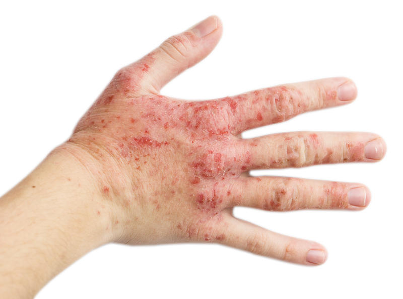 Dermatita atopică, Foto: Injenerker | Dreamstime.com